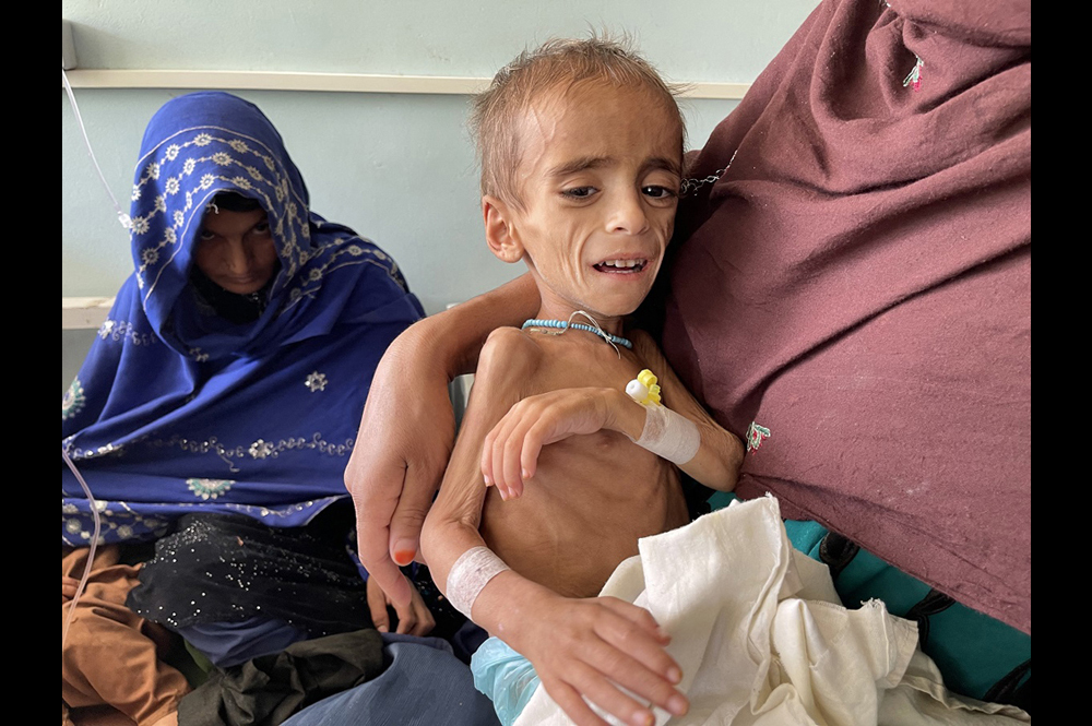 A malnourished Afghan child is treated at a hospital in Kandahar. [asiatimes.com | AFP / Murteza Khaliqi / Anadolu Agency]